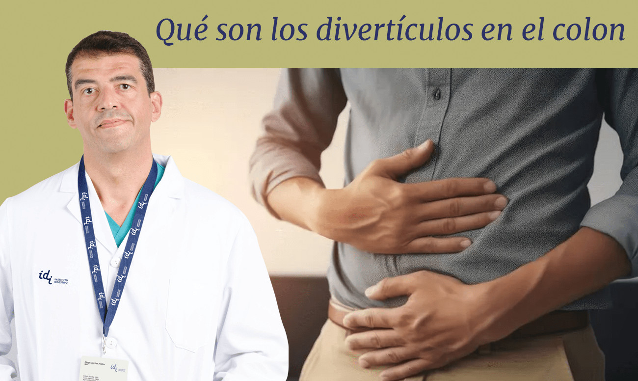 qué son los divertículos en el colon, y cómo prevenirlos